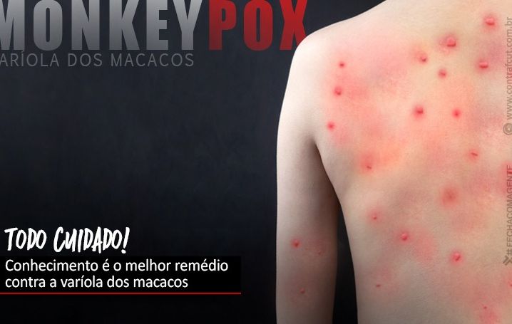 Varíola dos macacos: prevenção é a palavra de ordem